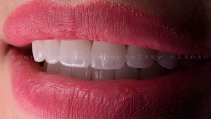 عيادة Bluedent Dental التخصصية - مسقط - +968 9133 4555